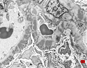 M,20y. | membranous glomerulopathy M,20y. | membranous glomerulopathy